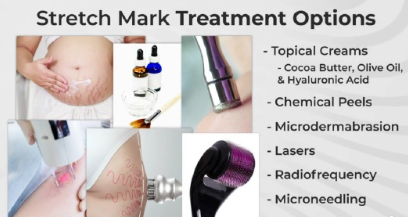 stretch mark treatment options